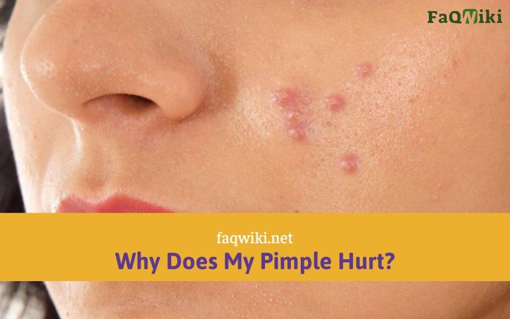 Why Does My Pimple Hurt?