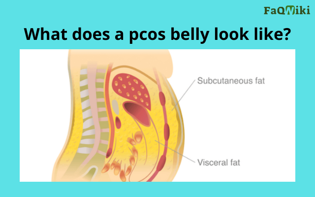 what does a pcos belly look like