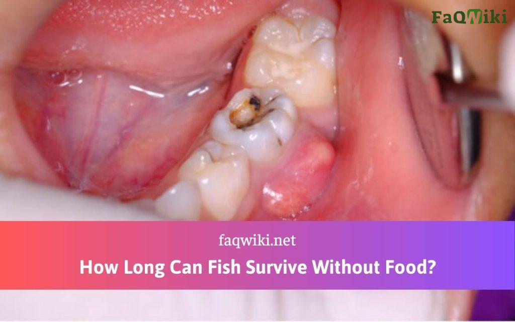 How Long Can a Tooth Infection Go Untreated?