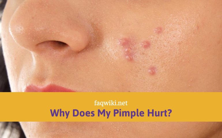Why Does My Pimple Hurt?